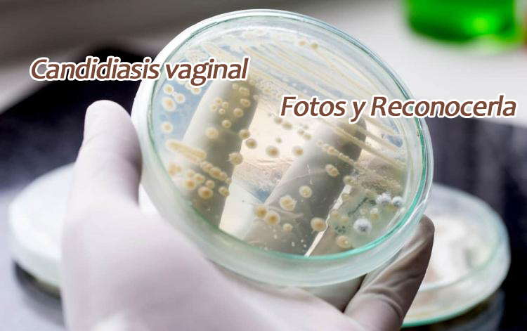 Candidiasis vaginal Fotos y ejemplos para reconocerla