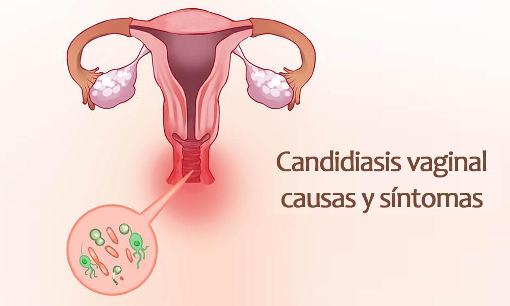 Candidiasis vaginal: causas y cómo prevenirla