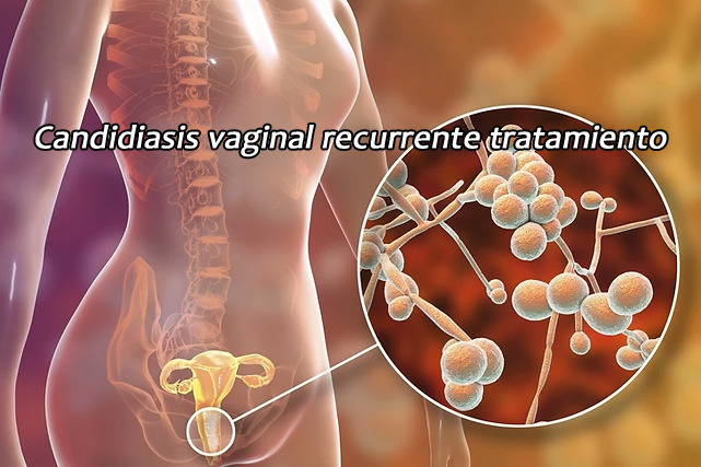 Candidiasis vaginal recurrente tratamiento efectivo