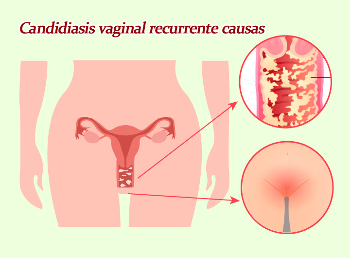 Candidiasis vaginal recurrente causas y cómo prevenirla