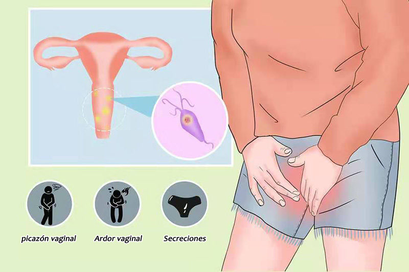 Candidiasis vaginal tratamiento natural: opciones aliviar síntomas