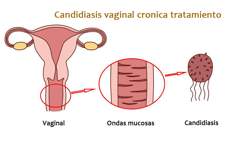 Candidiasis vaginal crónica: Tratamiento y consejos