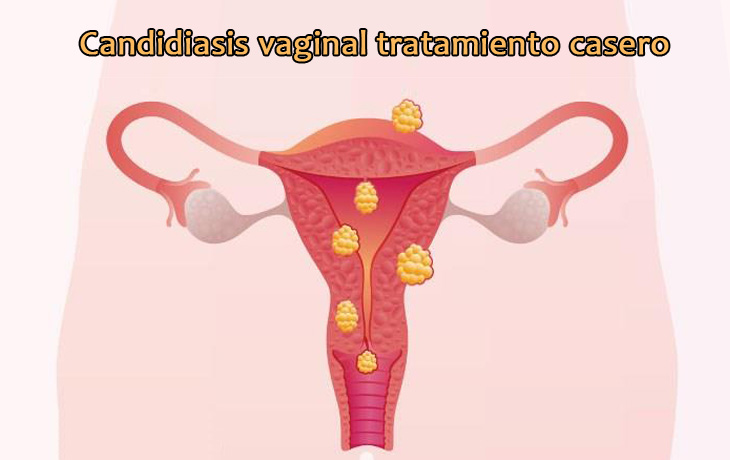 Candidiasis vaginal Tratamiento casero prácticas y seguras